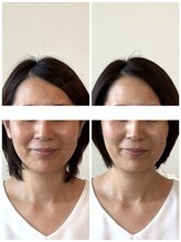 リフェイスフサエ(ReFace Fusae)/富士シャープな顎 リフトアップ