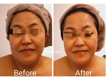 サラサ(SARASA)/むくみ解消して小顔に