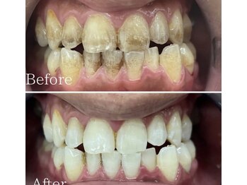 ホワイト 福岡天神店(WHITE)/ホワイトニングビフォーアフター