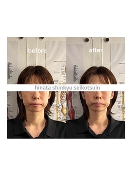 ひなた鍼灸整骨院 大類院/美容鍼