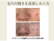BUB 立川/毛穴の開きを改善したい方へ