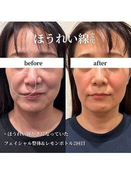 フェアリーフェイス 南森町店(Fairy Face)/南森町/小顔矯正&レモンボトル