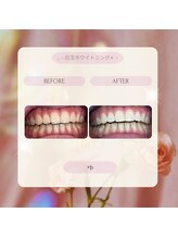 プラスビーセルフ(+b self)/ホワイトニングビフォーアフター