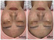 シルク(Cilk)/ハーブクリームピーリング