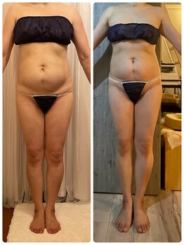 ティアラ/痩身 Before&After