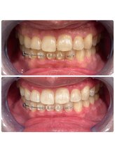 エクシアホワイトニング 日本橋店/人形町ホワイトニング