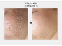 ベル 新橋(Belle)/ハーブピーリング×ダーマ