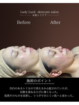 レディラック 大阪梅田本店(Lady Luck)/シミ集中ケアコース