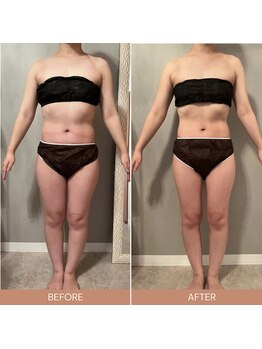 リファラ 光の森店(REFALA)/【痩身/20代女性】約3ヶ月の結果