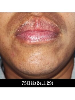 レイ(R.E.I)/【脱毛アフター】口周り