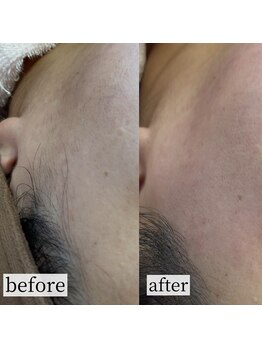 チアリー(Chiary)/フェイシャルワックス/顔脱毛