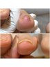 【初回】巻き爪ケア　親指２本（カウンセリング料/爪切り１０本込み）
