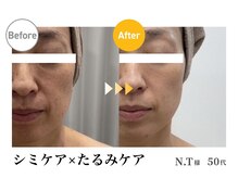 アルゴ 春日那珂川店(ALGO)/しみたるみの改善でお肌スッキリ