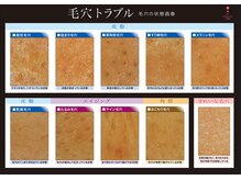 ポアレスラボ 東武百貨店池袋店/毛穴トラブル分類