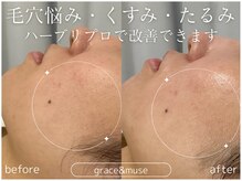 グレイス アンド ミューズ(grace&muse)/【HAAB REPRO】ハーブピーリング