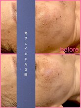 ミレボ(Me.rebo)/光フェイシャルbefore→after