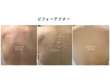 ハーブピーリング♪お肌に合わせて剥離ありなし選べます！！