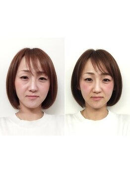 ユウキシキ(YUKISIKI)/YUKISIKI小顔矯正&美容鍼