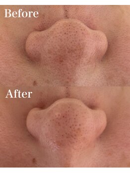 ウル(ULu)/毛穴のお悩み