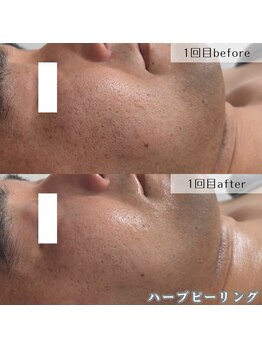 ネイルズビー 別邸(Nail's be)/毛穴に特化！メンズも肌質改善