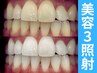 【通い放題/回数券】20分×3回美容ホワイトニング【東中野/中野/中野坂上】