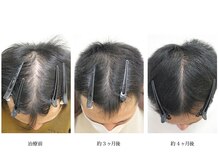 メンズ asc(men's asc)/ヘッドスパ1