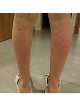 セシオ(SEACIO)/冷えによる血流の悪さ(うろこ状)