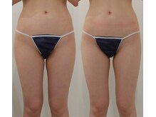 クレール アオヤマ(CLAIRE AOYAMA)/【1回】ひざ上、内ももスッキリ