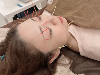 名古屋鍼灸 美容健康院の写真/《志段味◆鍼施術》４０代５０代になって気になるホウレイ線,たるみを美容鍼で改善!感動の結果へ