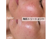 シュカ(Shuka)/ハーブピーリング