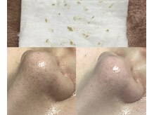 エミルカ 仙台(EMILUCA)/毛穴トラブル根本改善コース