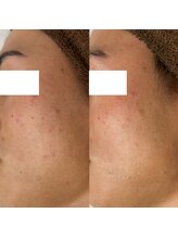 アエオボンヌール(A.E.O BONHEUR)/ハーブピーリング2回