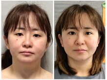 ブログに小顔矯正写掲載♪お顔を小さく＆リフトアップ＆歪み改善