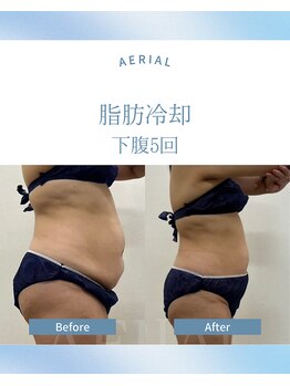 エアリアル 武雄店/脂肪冷却