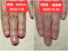 マニブルーム/初回と5回目　左手