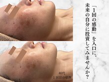 リボーン 柏(REBORN)/肌が喜ぶ“削らないシミケア”