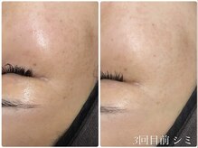 エル(Elle)/産後のシミ 2回目前比較
