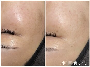 エル(Elle)/産後のシミ 2回目前比較