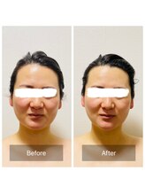 ヒール(heal)/【30代】二重顎のお悩み