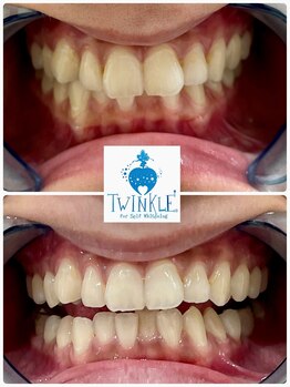 ティンクルホワイト 橿原店/見違える歯に！！