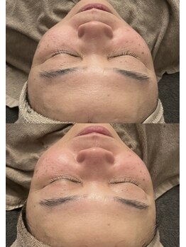 ベル(Belle)/ポレーションbefore→after