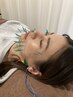 電気を流す美容鍼灸+部分鍼灸20分¥9000→¥6000