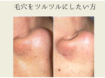 BUB 立川/毛穴をツルツルにしたい方へ