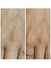 サナ 久が原 千鳥町(S’ana)/ハーブピーリング