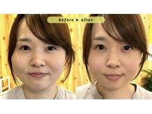 エヴァ ナゴヤ(EVA nagoya)/小顔矯正