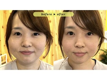 エヴァ ナゴヤ(EVA nagoya)/小顔矯正