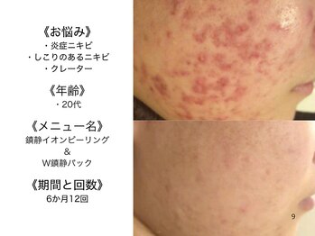 アクール(Accueil)/毛穴ケア/肌質改善/ニキビケア