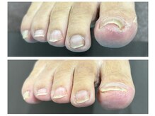 イルミナ(illumina)/巻き爪矯正（１回）