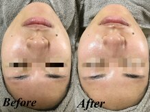 リララ 江坂店(Lelala)/艶肌ワックス☆ビフォーアフター