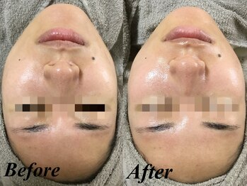 リララ 江坂店(Lelala)/艶肌ワックス☆ビフォーアフター